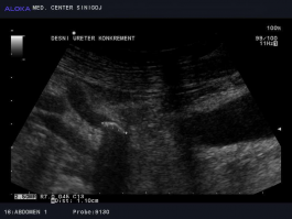 Ultrazvok ledvic - ledvični kamen v desnem sečevodu 2